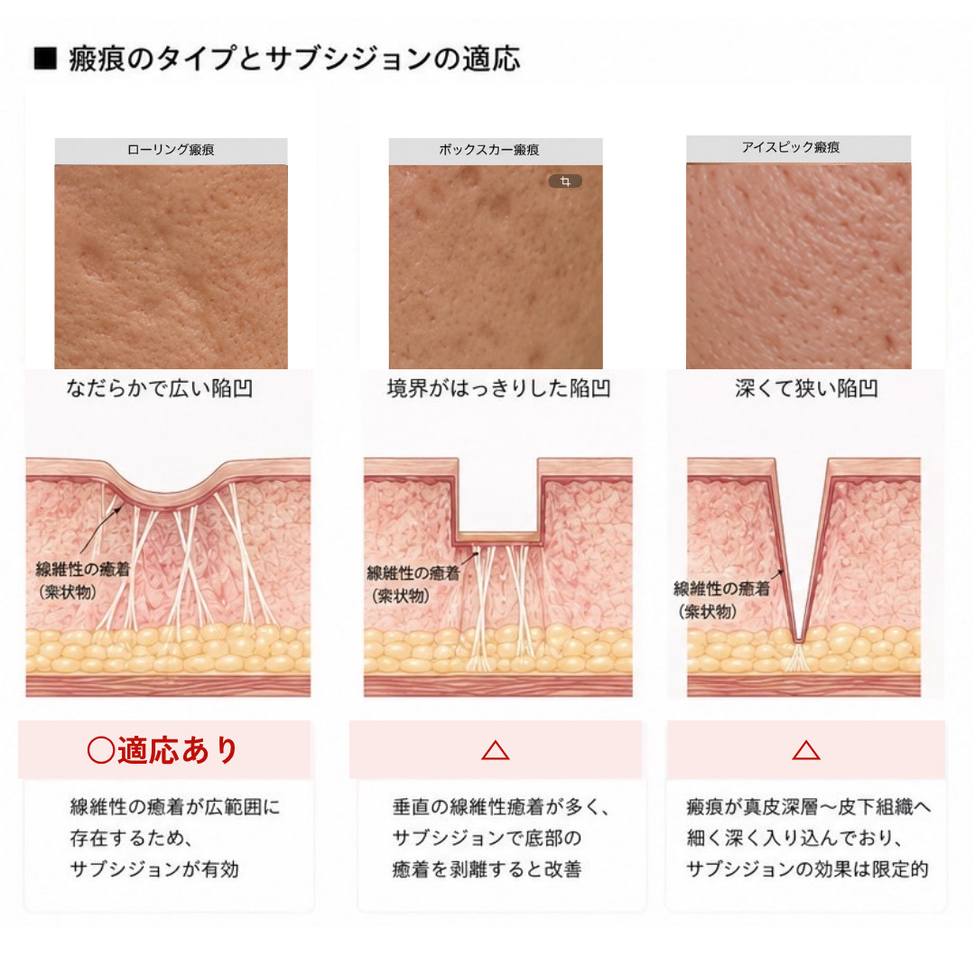 サブシジョン 治療のメカニズム解説